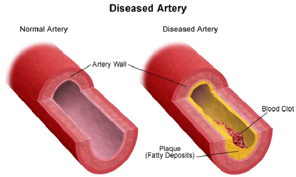 /NormalAndDiseasedArtery